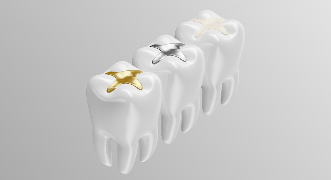 Tooth-Colored Fillings in Kettering, OH
