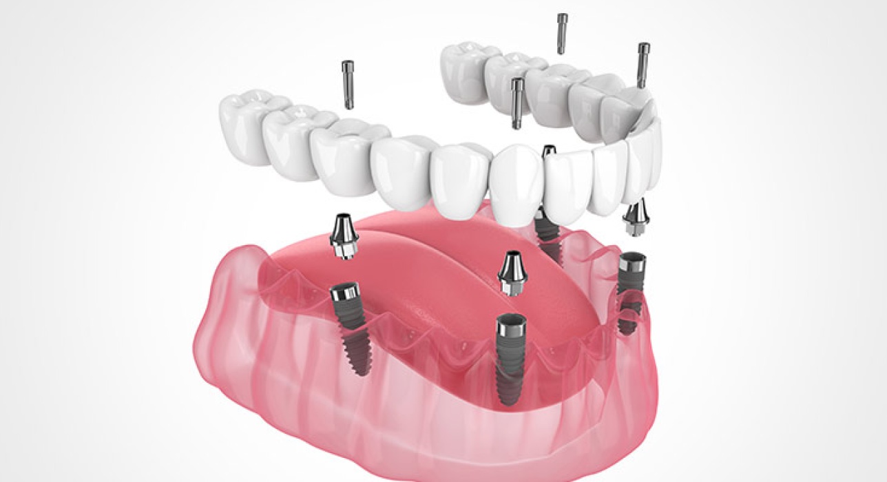 Implant-Supported Dentures in Kettering, Ohio