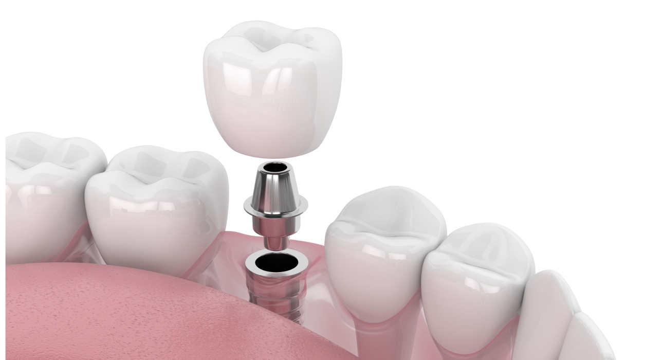single dental implants in Kettering, OH