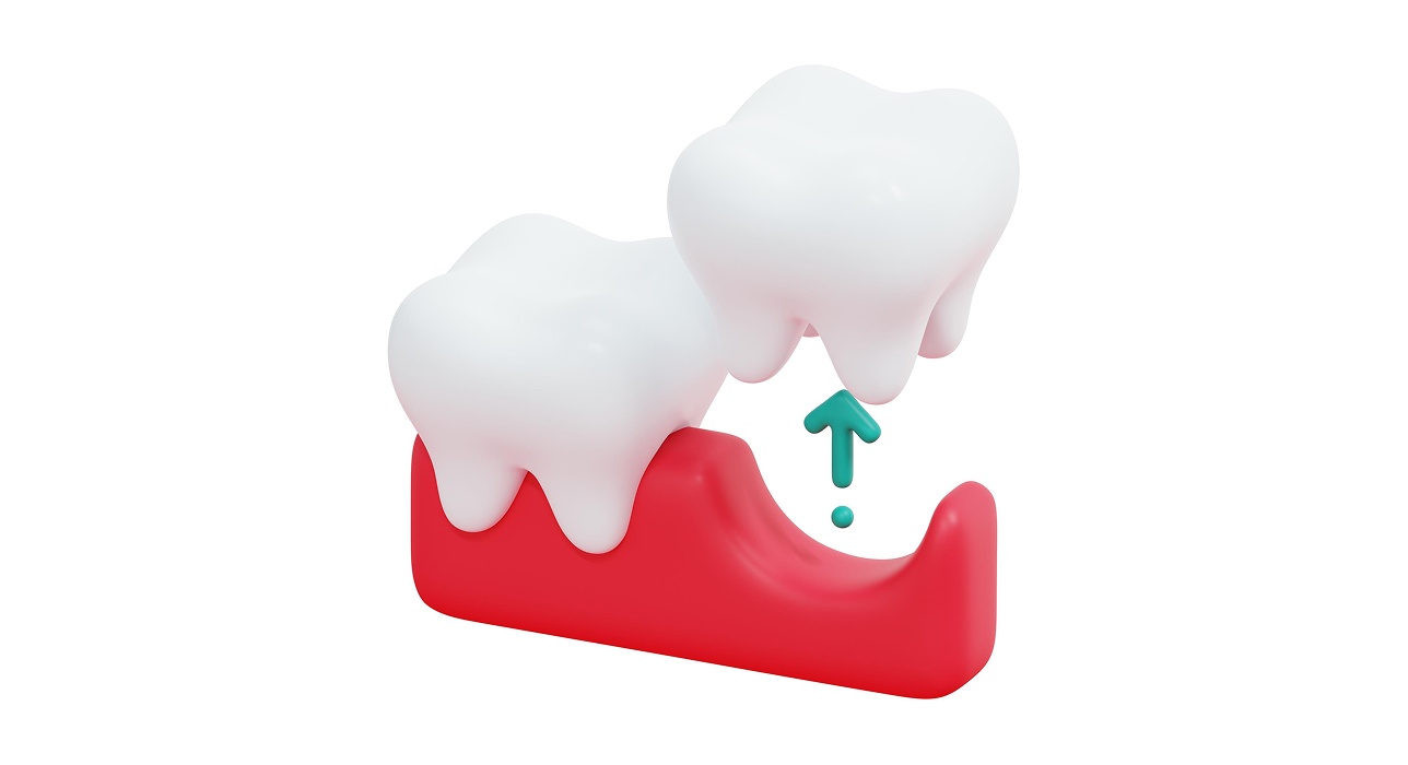 Tooth Extractions
